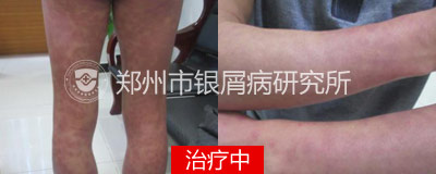 没想到老王吃了不到10天,身上的红疹大面积扩散,成了一块块红斑片